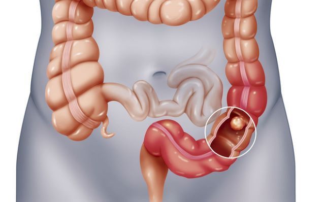 Ung thư đường ruột là căn bệnh phổ biến ở cả nam giới và nữ giới