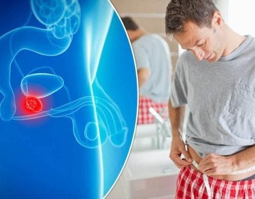 Nguy cơ mắc bệnh ung thư tuyến tiền liệt tăng nhanh ở độ tuổi ngoài 50