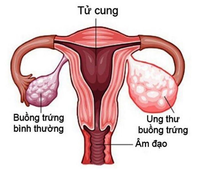 Ung thư buồng trứng là căn bệnh gây tử vong cao trong các bệnh ung thư ở phụ nữ