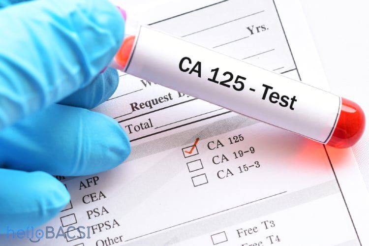 Xét nghiệm CA-125 giúp phát hiện ung thư buồng trứng