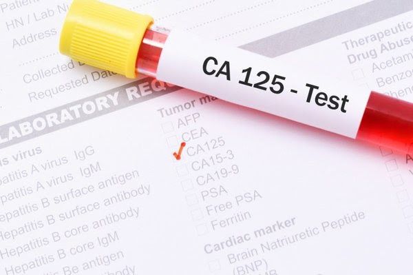 Một trong những xét nghiệm ung thư buồng trứng quan trọng là xét nghiệm CA 125