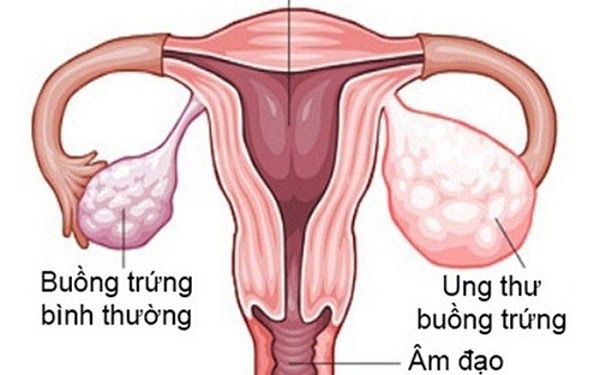 Ung thư buồng trứng ngày càng gia tăng