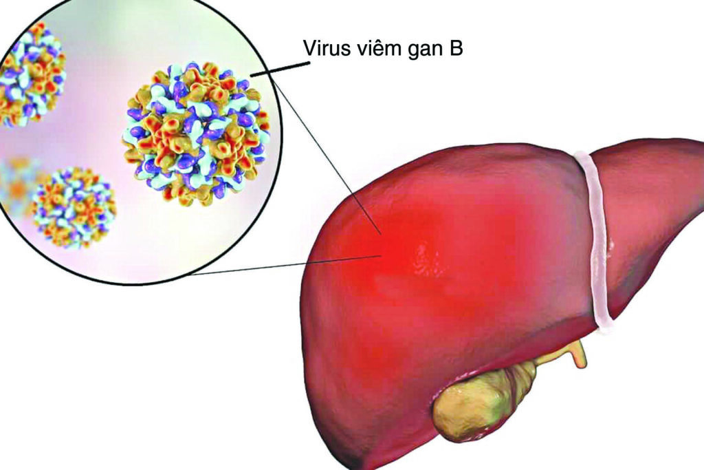 Virus viêm gan B là một trong những yếu tố hàng đầu tăng nguy cơ ung thư gan
