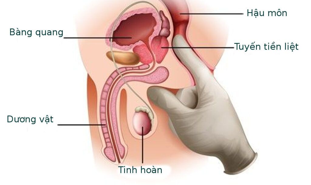 Hiện nay vẫn chưa xác định được nguyên nhân cụ thể gây ung thư tuyến tiền liệt
