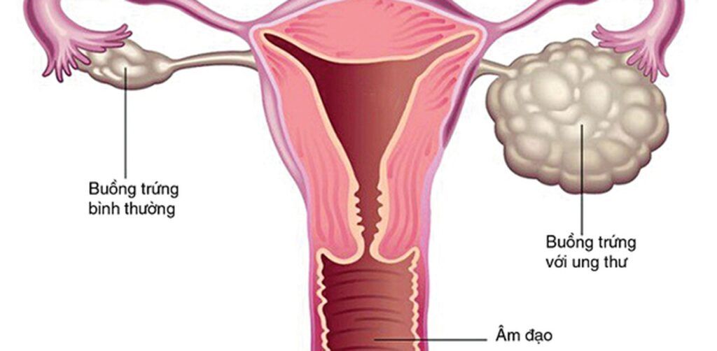 Có đến 70% bệnh nhân ung thư buồng trứng phát hiện khi bệnh đã ở giai đoạn muộn (giai đoạn 3, 4)