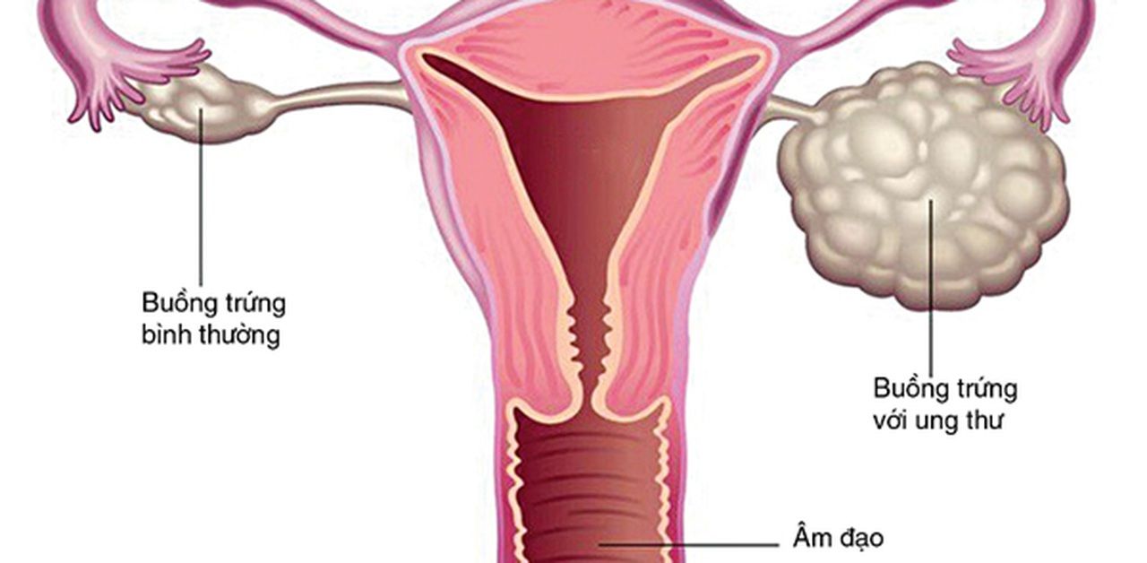 Ung thư buồng trứng giai đoạn 3 là giai đoạn mà ung thư đã phát triển từ buồng trứng lan sang phần màng bụng hoặc các hạch bạch huyết trong ổ bụng