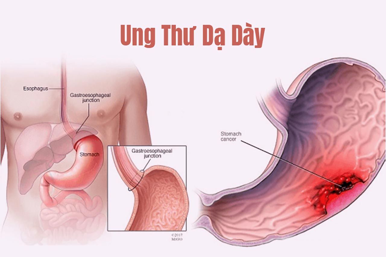 Ung thư dạ dày là bệnh lý ác tính gây tử vong cao và thường chỉ được phát hiện ở giai đoạn muộn