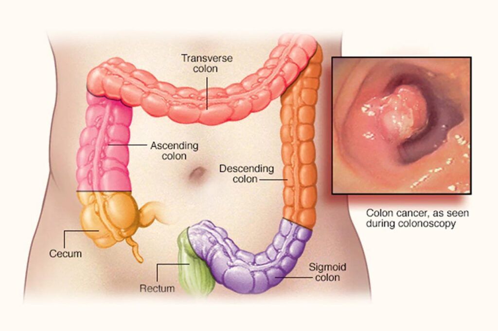 Sự bất thường trong ADN của tế bào là một trong những nguyên nhân gây ung thư trực tràng