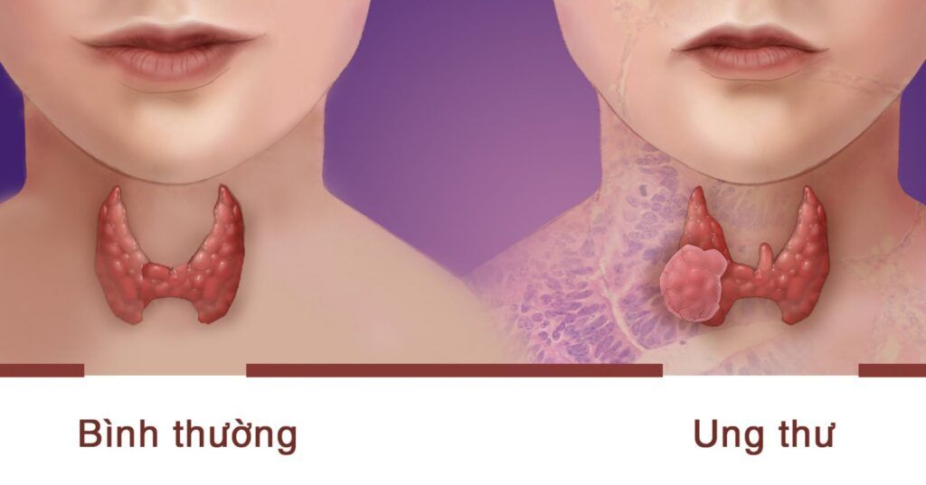 Ung thư tuyến giáp có nguy hiểm không là thắc mắc của nhiều người