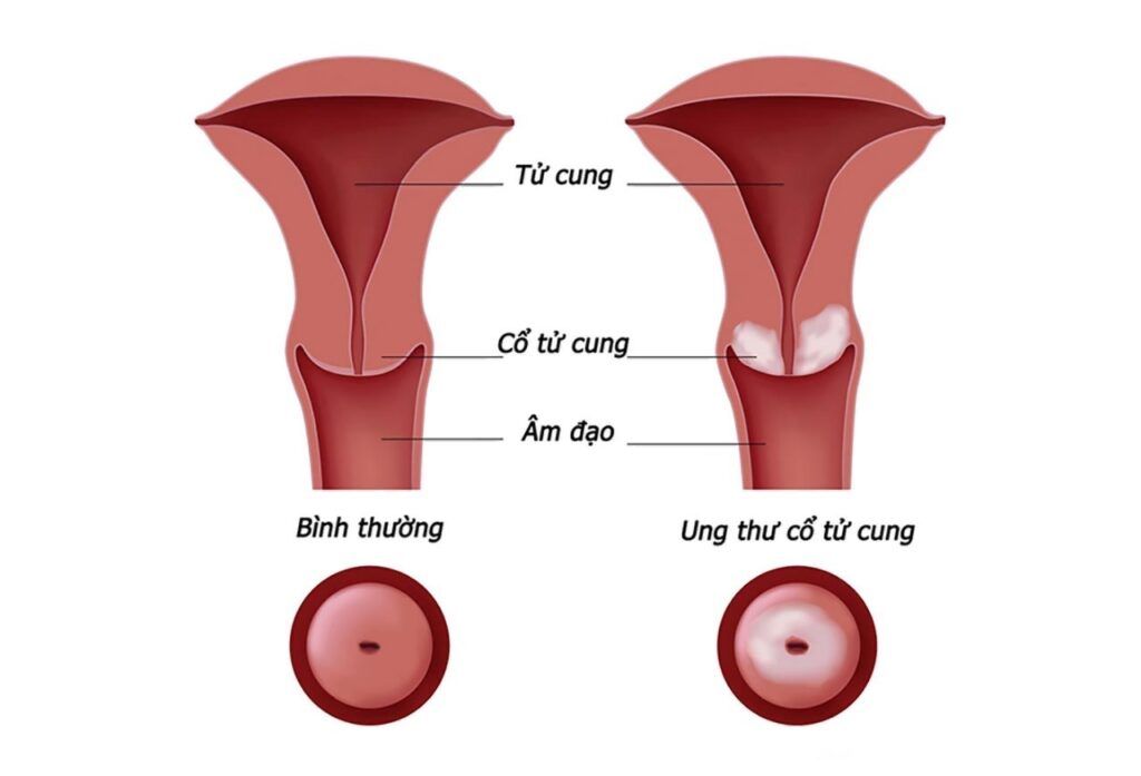 Ung thư cổ tử cung là loại ung thư thường gặp ở phụ nữ ở các nước kém phát triển, chỉ đứng thứ 2 sau ung thư vú