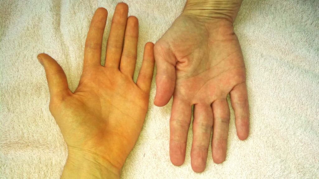 Vàng da là một trong những dấu hiệu ung thư gan điển hình
