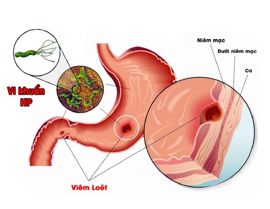 Vi khuẩn HP là một trong những yếu tố nguy cơ làm tăng khả năng mắc bệnh