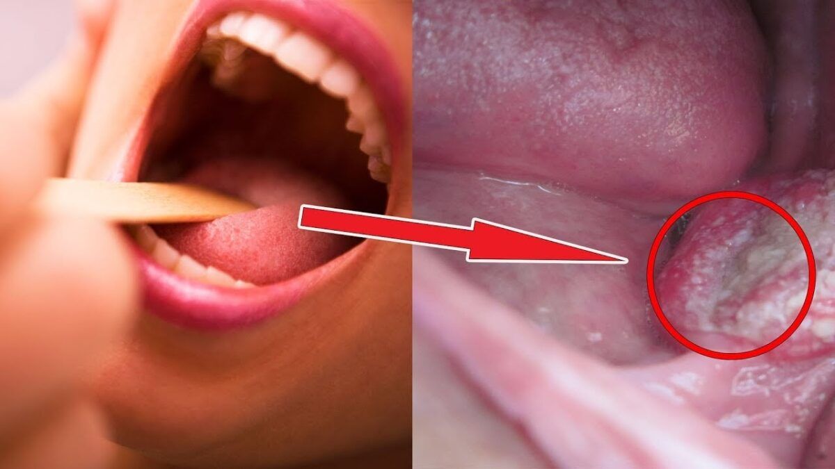Ung thư vòm họng là bệnh lý nguy hiểm ngày càng gia tăng và trẻ hóa