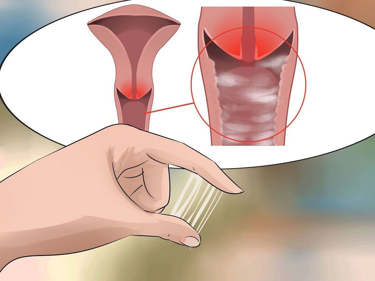 Khí hư bất thường có thể là dấu hiệu ung thư cổ tử cung
