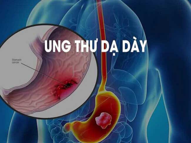 dau-hieu-ung-thu-da-day_18
