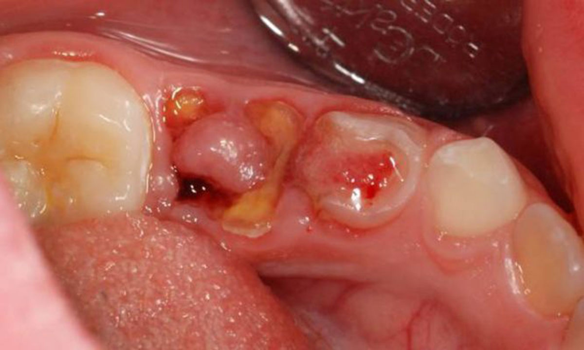 Có những nghiên cứu và phát triển mới nhất về ung thư răng hàm?