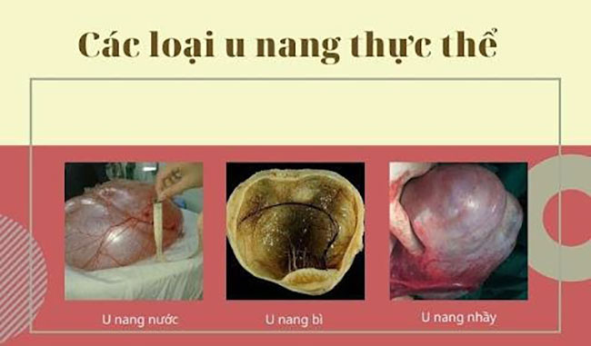 u-nang-buong-trung-phat-trien-thanh-ung-thu-2