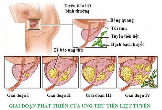 cac-giai-doan-ung-thu-tien-liet-tuyen-1