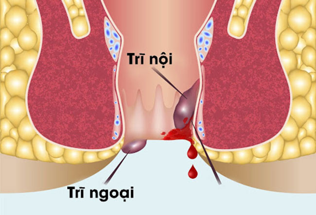 Bệnh lồi dom là gì và tại sao gây ra lồi thịt hậu môn?
