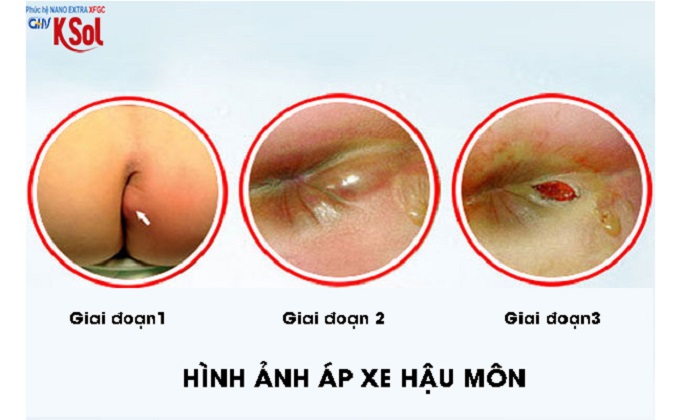 Áp xe hậu môn: Triệu chứng, nguyên nhân và cách điều trị hiệu quả