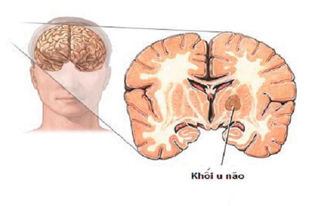 phau-thuat-u-nao-ac-tinh-3
