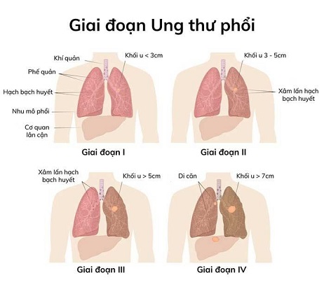 ung-thu-phoi-5