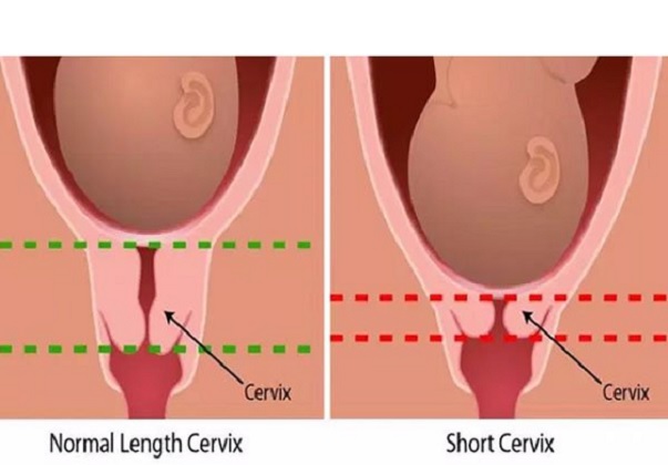 Có những dấu hiệu nào cho thấy cổ tử cung ngắn?

